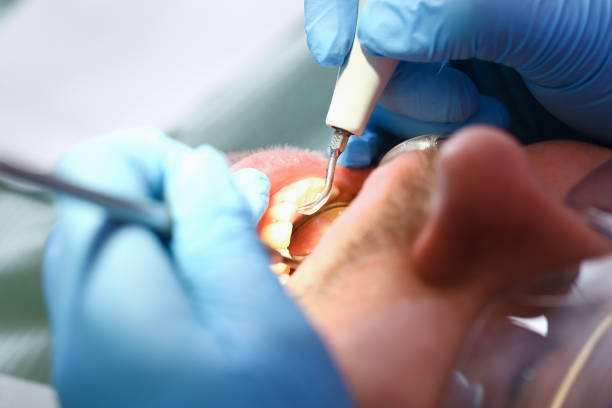 Best Emergency Treatment for Dental Infections or Abscesses in Irvine, CA