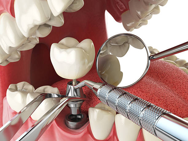 Best Emergency Dental Care for Broken or Chipped Teeth in Irvine, CA